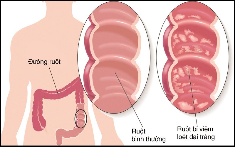 Nghệ có chứa hợp chất chống viêm tự nhiên